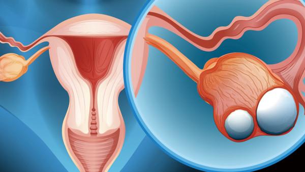卵巢癌吃什么食物能好转