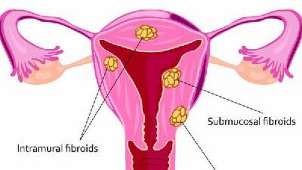卵巢癌生殖细胞肿瘤有哪些