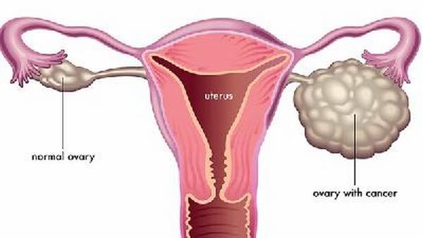浆液性卵巢癌是靠什么扩散