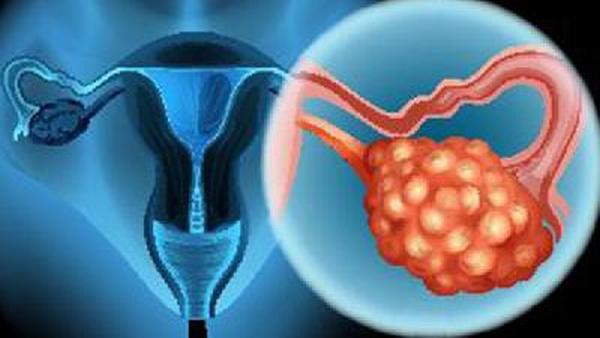 遗传卵巢癌凶险是什么原因