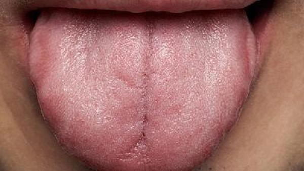舌癌原位复发是什么样