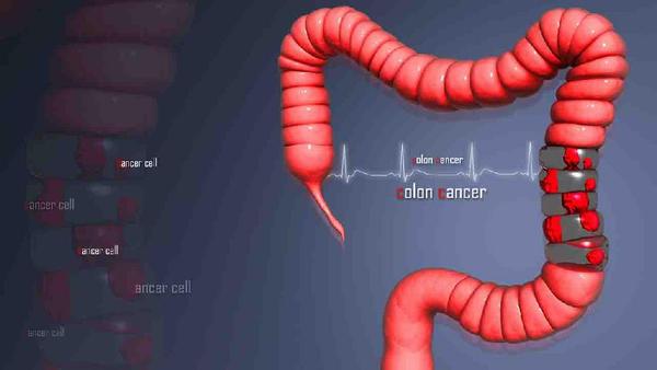 直肠癌吃什么可预防扩散