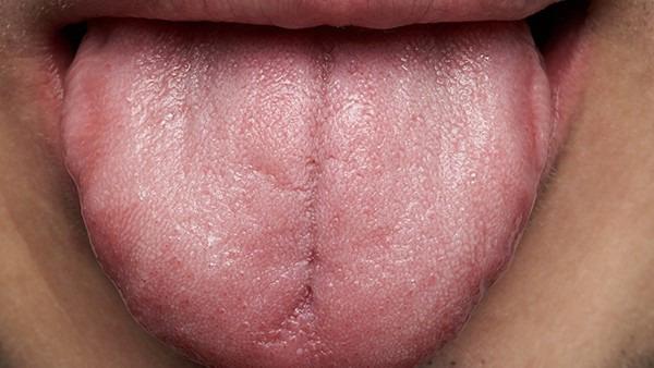 舌癌晚期痰多怎么办