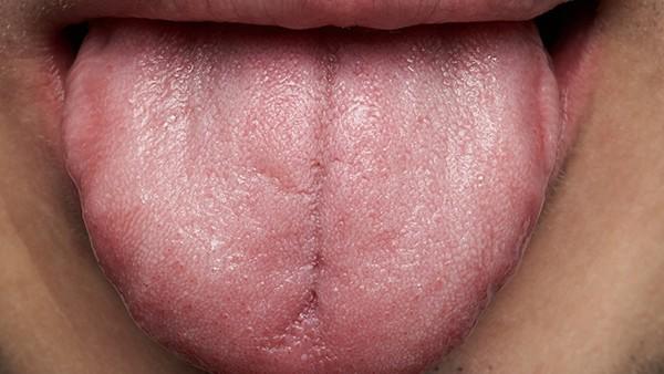舌癌手术后送什么