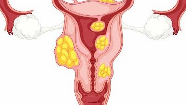 卵巢癌晚期有什么药止痛