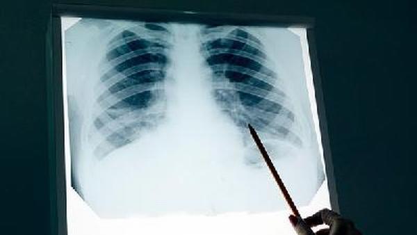 国内预防肺癌的疫苗有哪些