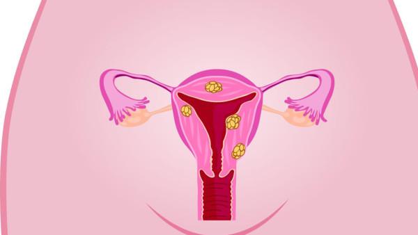 卵巢癌的标本是什么意思