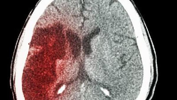 脑胶质瘤怎么确诊最准确