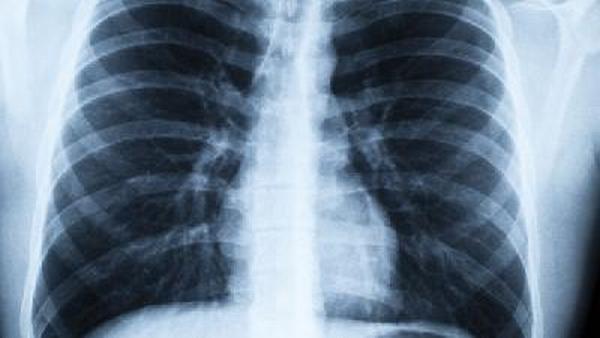 肺癌的5个前兆有哪些危害