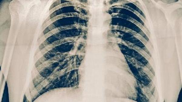为什么肺癌没有传染性呢