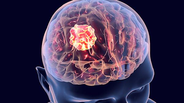 脑瘤发病原由是什么