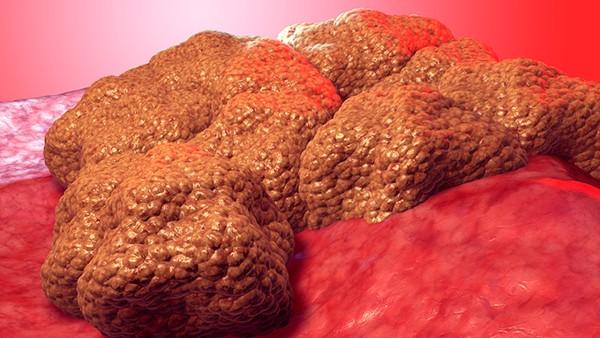 胰腺癌怎么预防黄疸