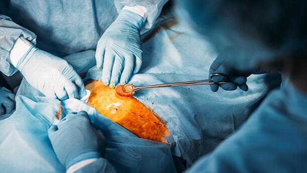 早期甲状腺癌做什么手术