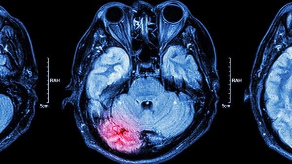 脑瘤钙化灶怎么预防