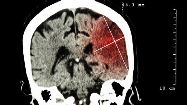 孩子脑瘤是什么引起