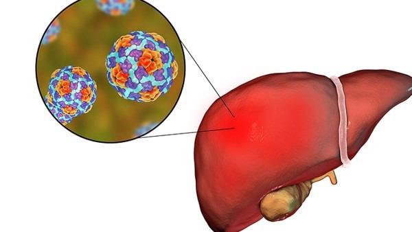 肝癌多少是肝炎