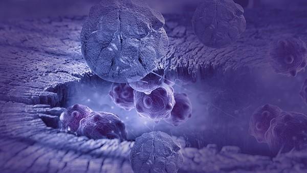 大肠癌的早期前兆能活多久