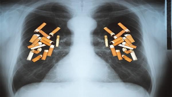 胸腔积液多久能确诊肺癌