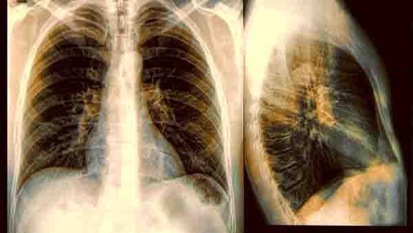 国内肺癌发病人数是多少