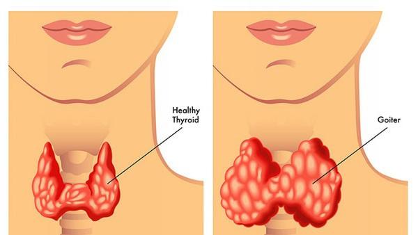 甲状腺癌变胖食物吃什么