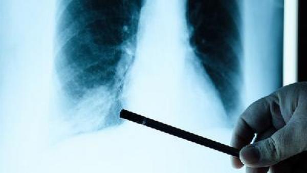 肺癌引起的感冒症状有哪些