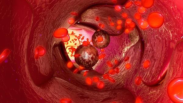 结肠癌肝转移四期能活多久