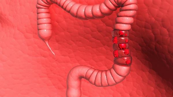 大肠癌腹泻的症状是什么