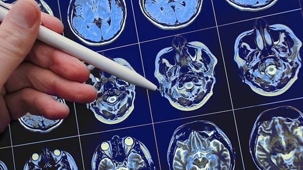 什么脑瘤引起偏头痛