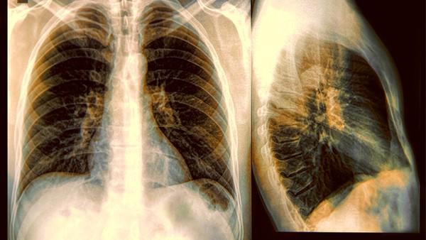 肺癌骨骼转移有哪些症状