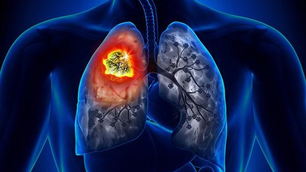 肺癌患者怎么缓解胃热呕吐