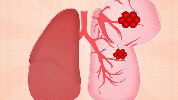 为什么得了肺癌会变黑呢