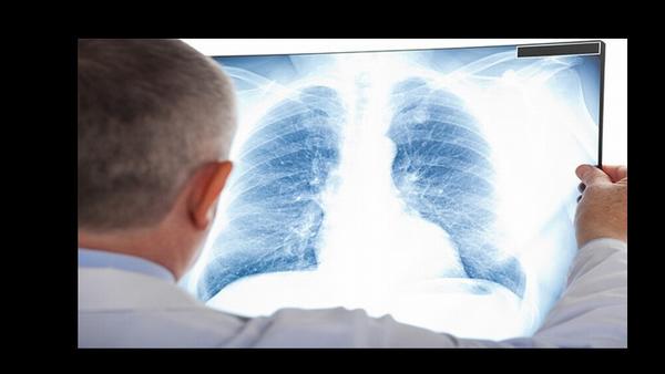 孝感治肺癌中医专家有哪些