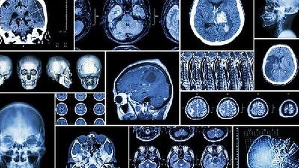 大脑胶质瘤能治愈吗多少钱