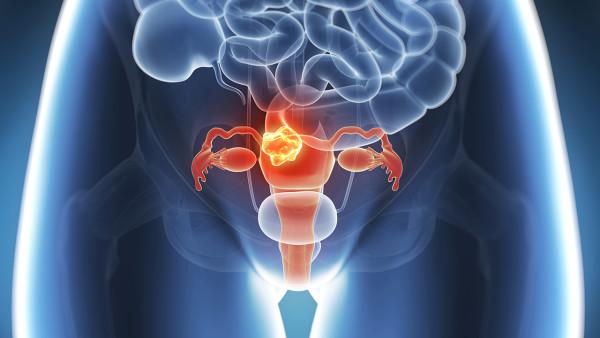 多囊如何避免卵巢癌