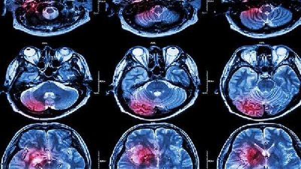桥脑恶性胶质瘤怎么检测